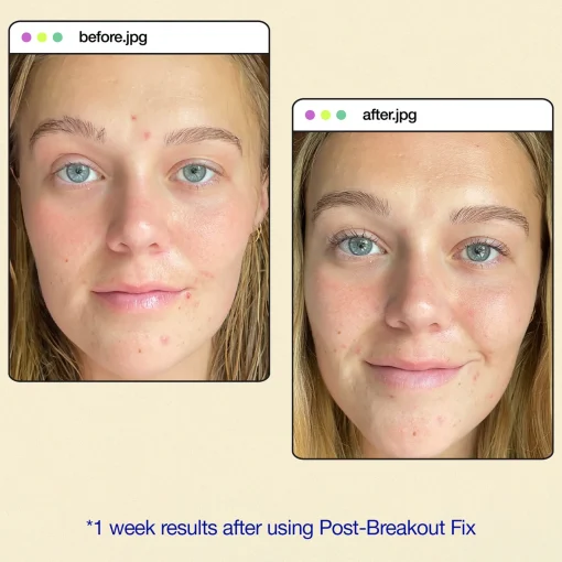 Dermalogica Clear Start™ Post-Breakout Fix 15ml Sale