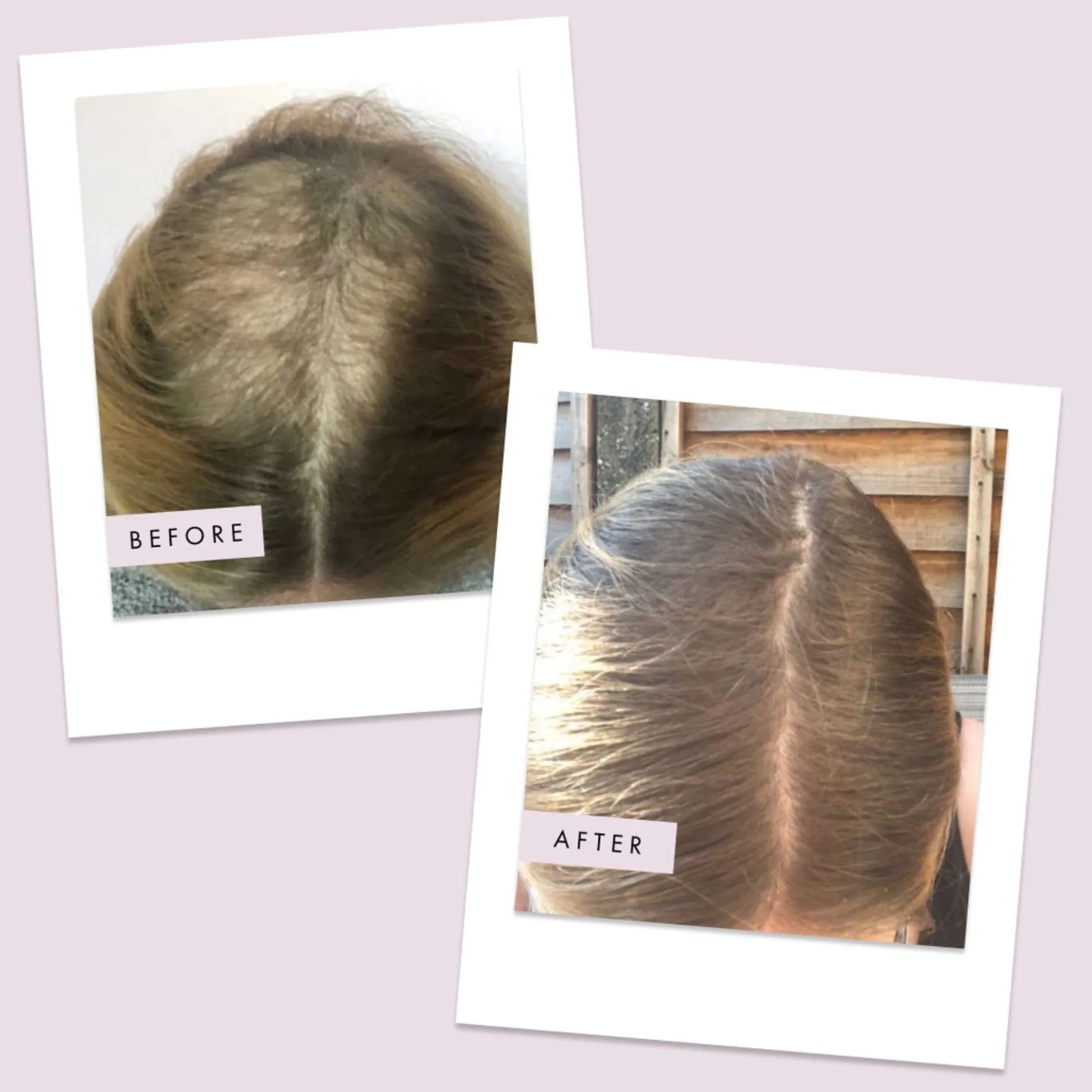 Hair Gain Hair Capsules Duo - 2 Month Supply x 120 Capsules Hot