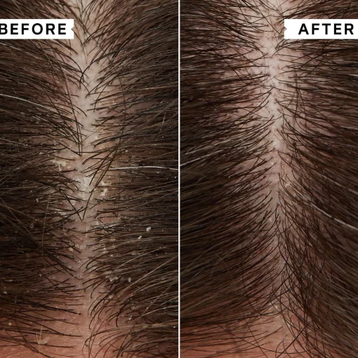 Philip Kingsley Masks Duo: Flaky/Itchy Scalp 2 x 20ml